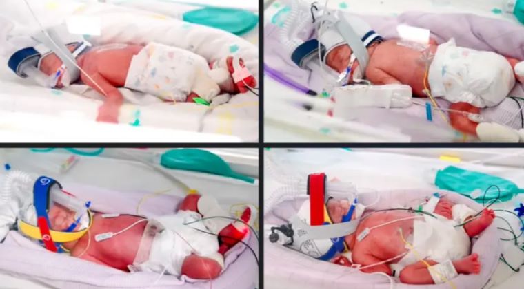 Australian Woman Welcomes Rare Identical Quadruplet Girls, Doctors Call It a One-in-15-Million Pregnancy